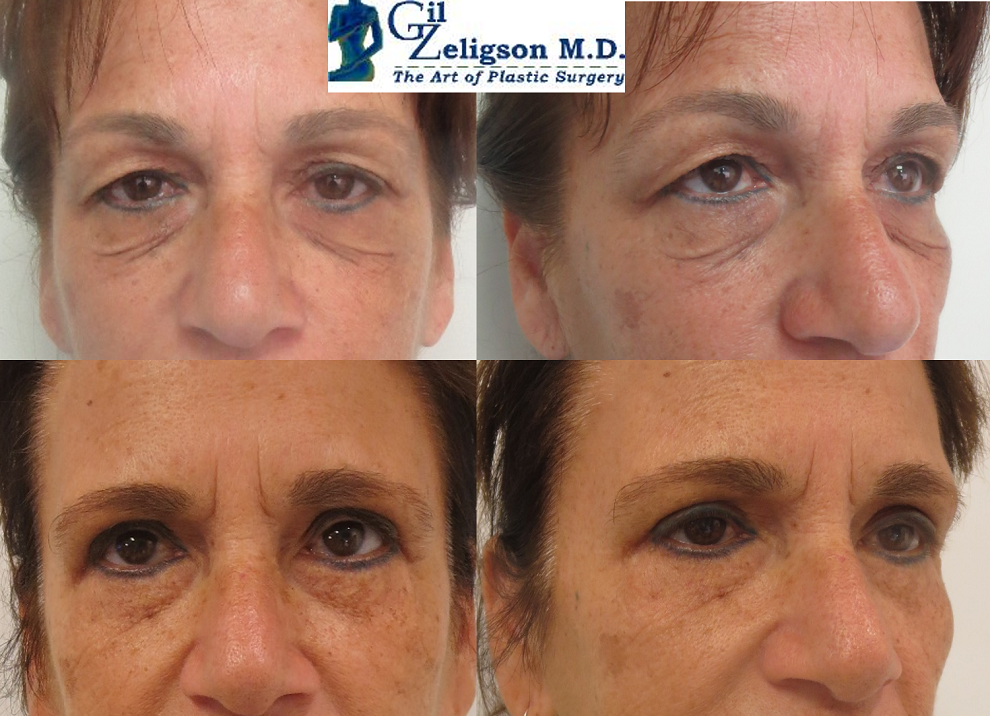 Dr. Gil Zeligson - Upper and Lower Eyelids