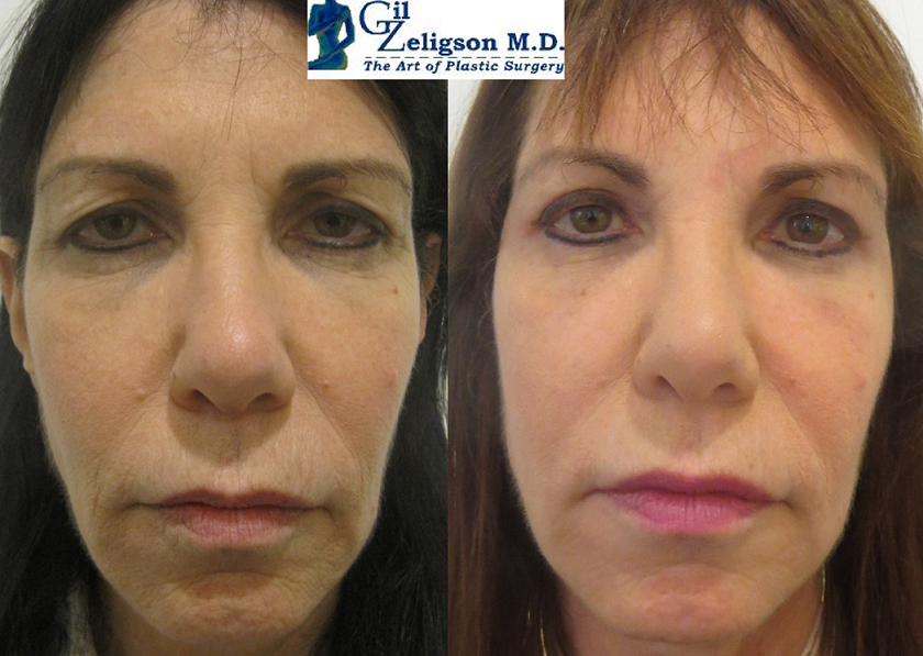 Dr. Gil Zeligson - Upper and Lower Eyelids