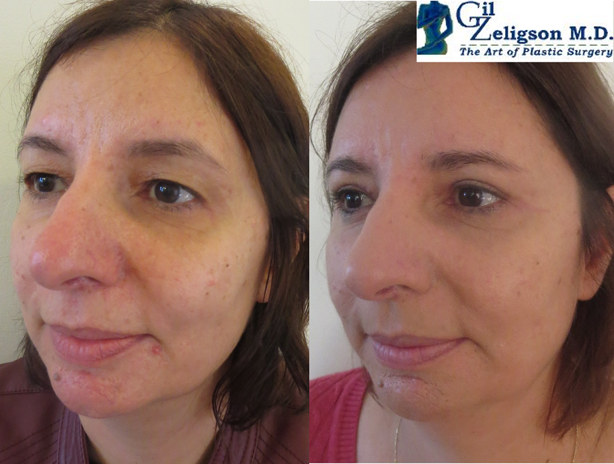 Dr. Gil Zeligson - Upper and Lower Eyelids