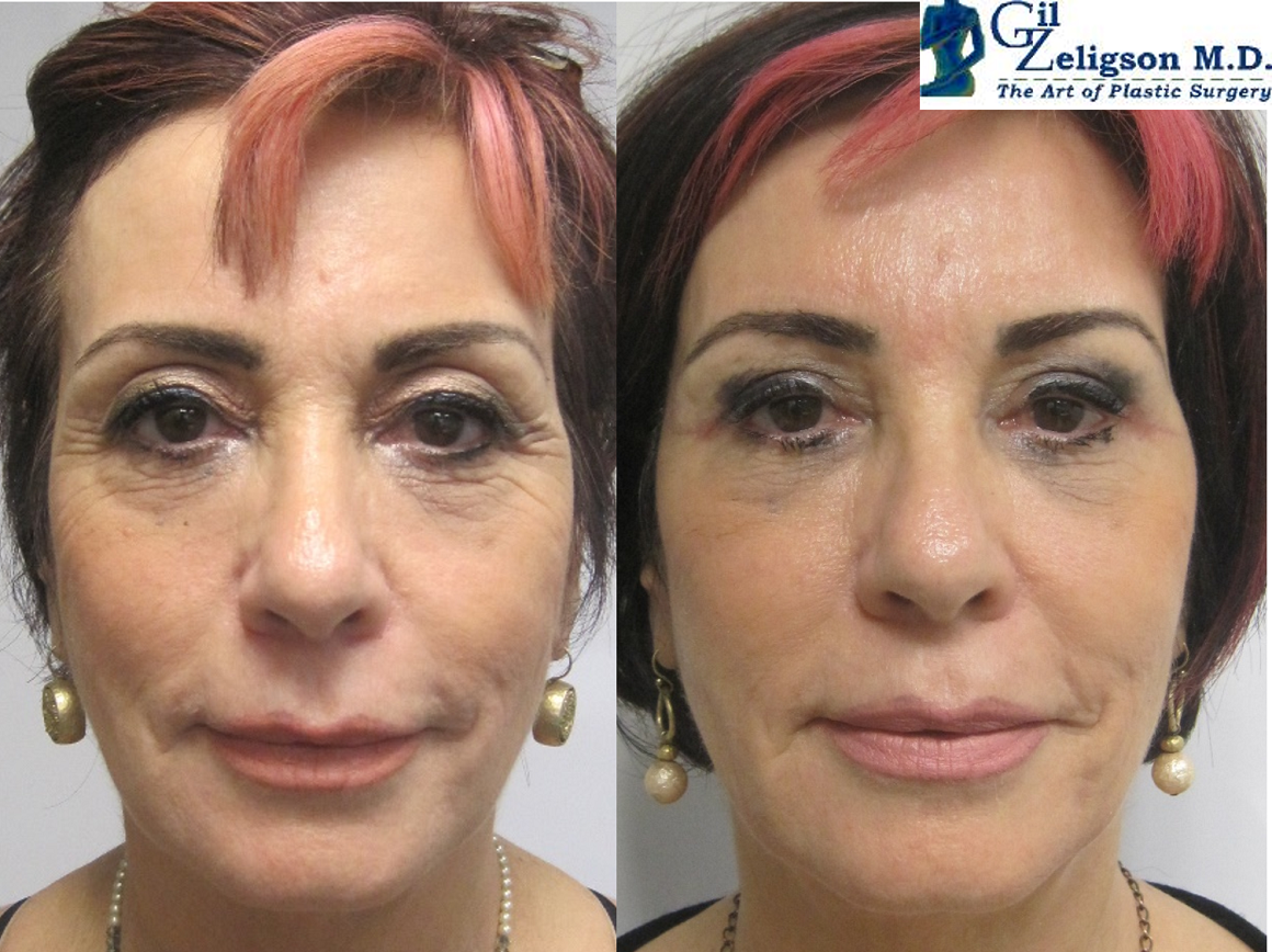 Dr. Gil Zeligson - Upper and Lower Eyelids