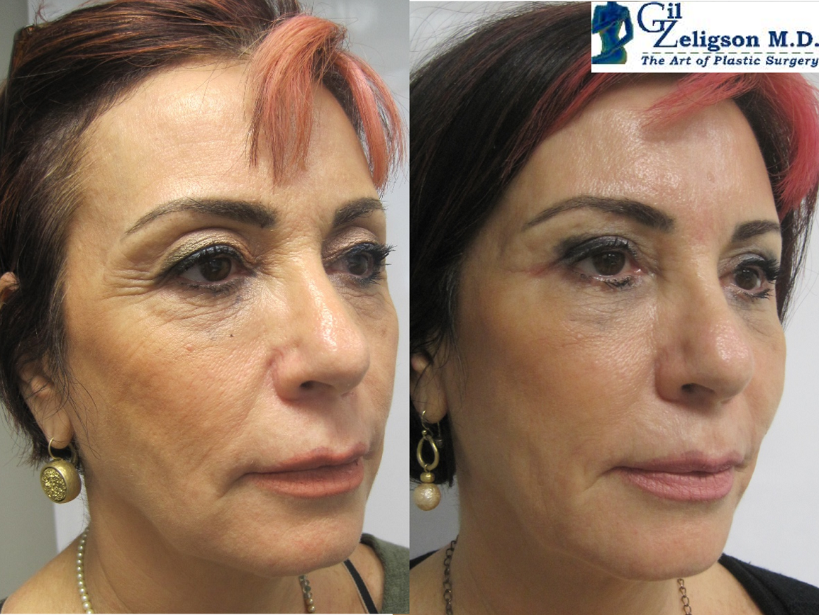 Dr. Gil Zeligson - Upper and Lower Eyelids