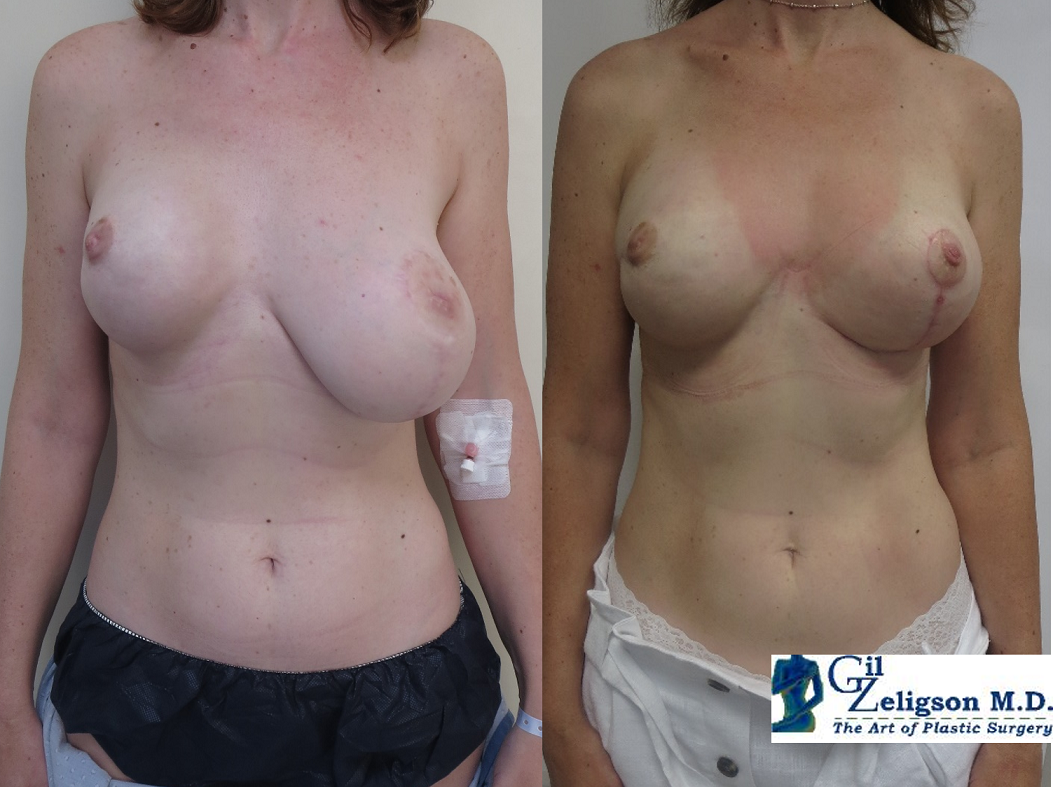 Dr. Gil Zeligson - Breast Asymmetry Correction