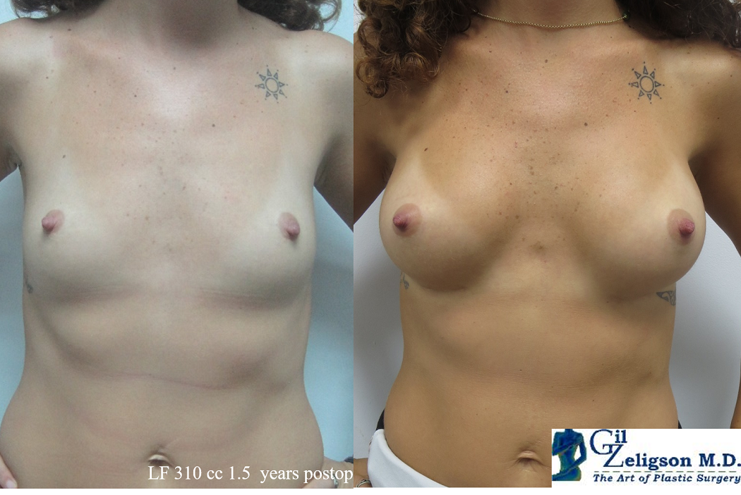 Dr. Gil Zeligson - Breast augmentation