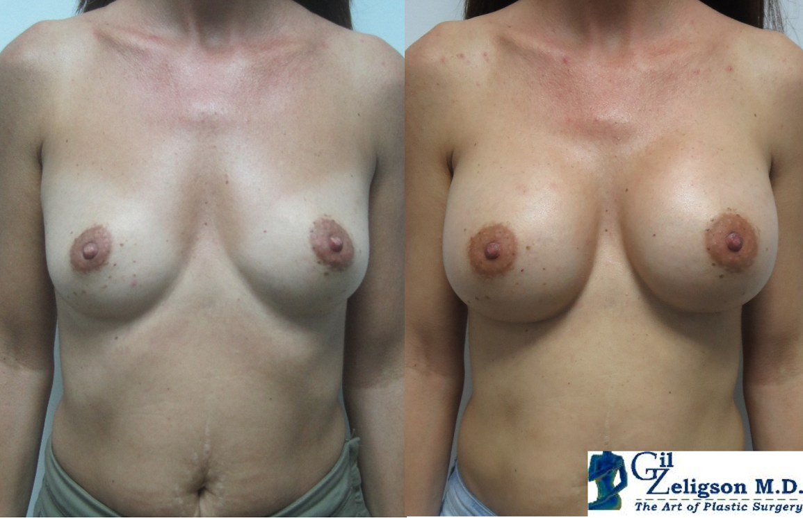 Dr. Gil Zeligson - Breast augmentation