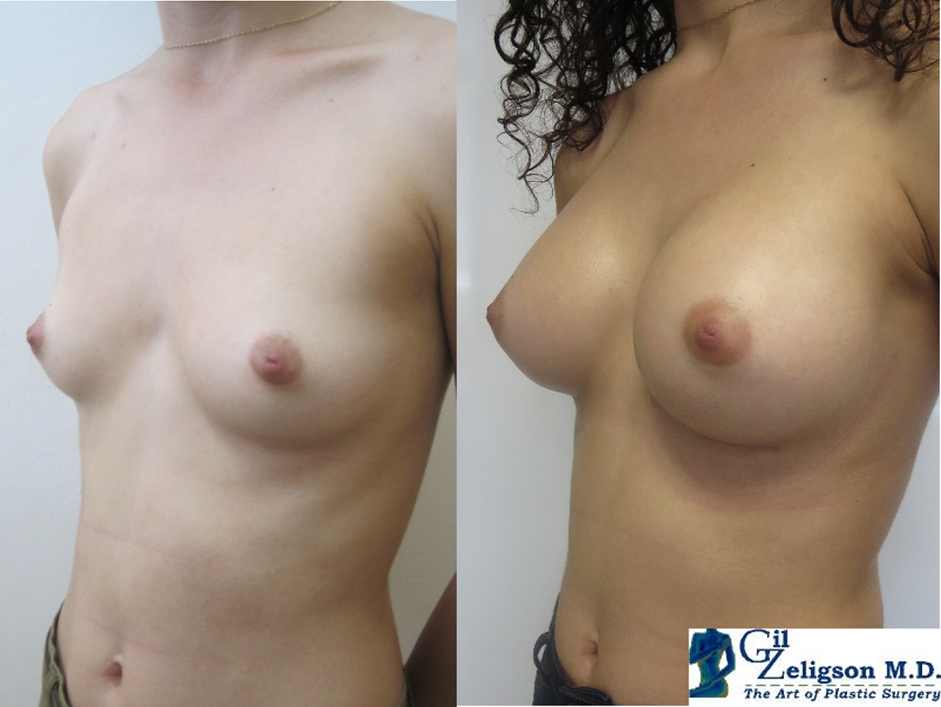 Dr. Gil Zeligson - Breast augmentation