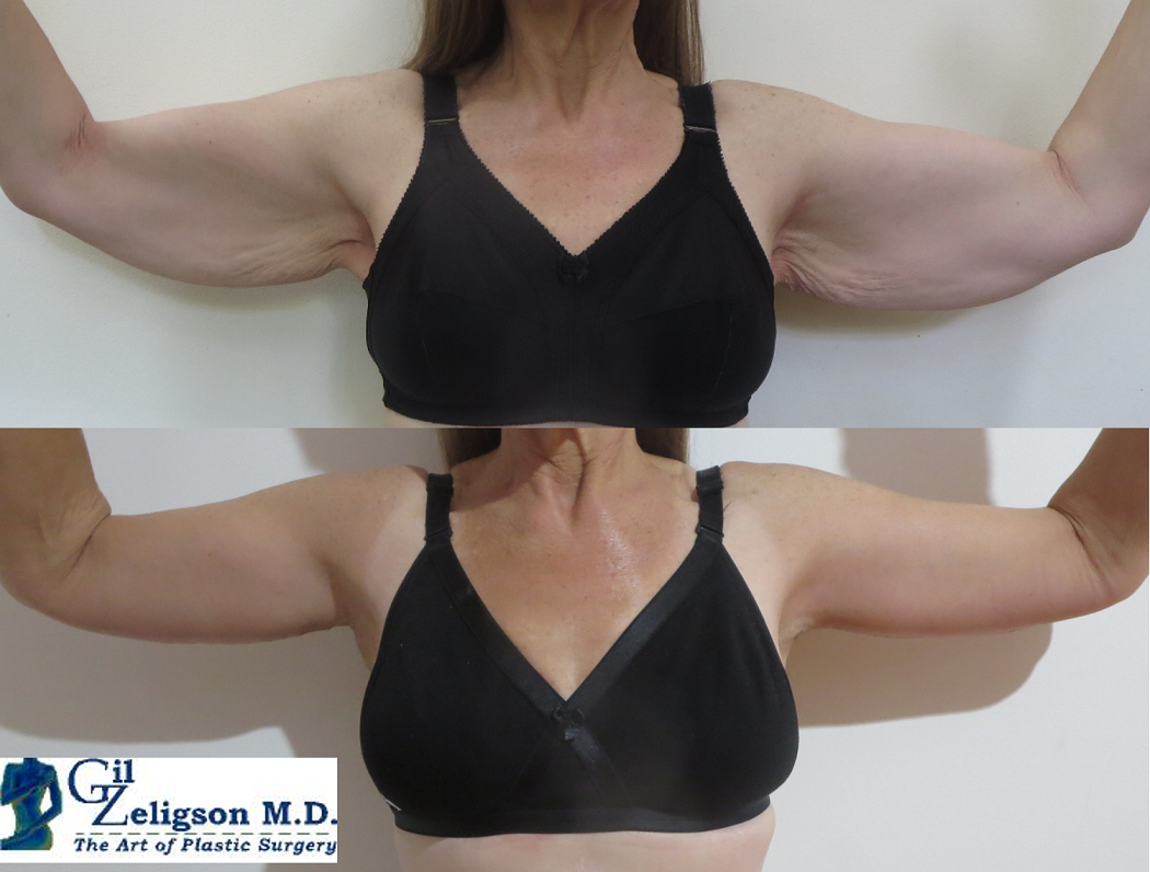 Brachioplasty Thigh Lift