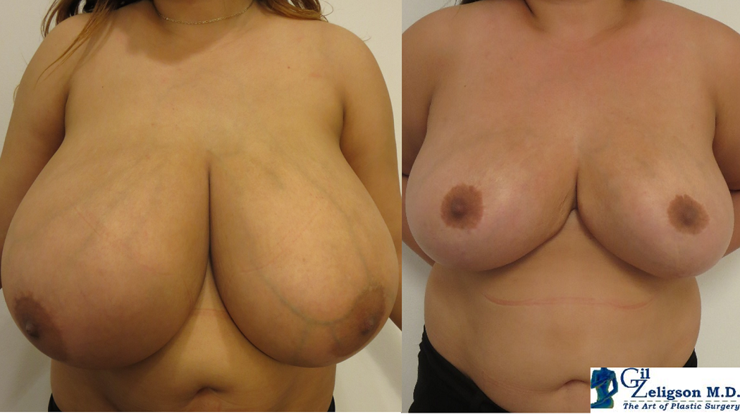Dr. Gil Zeligson - Breast Reduction