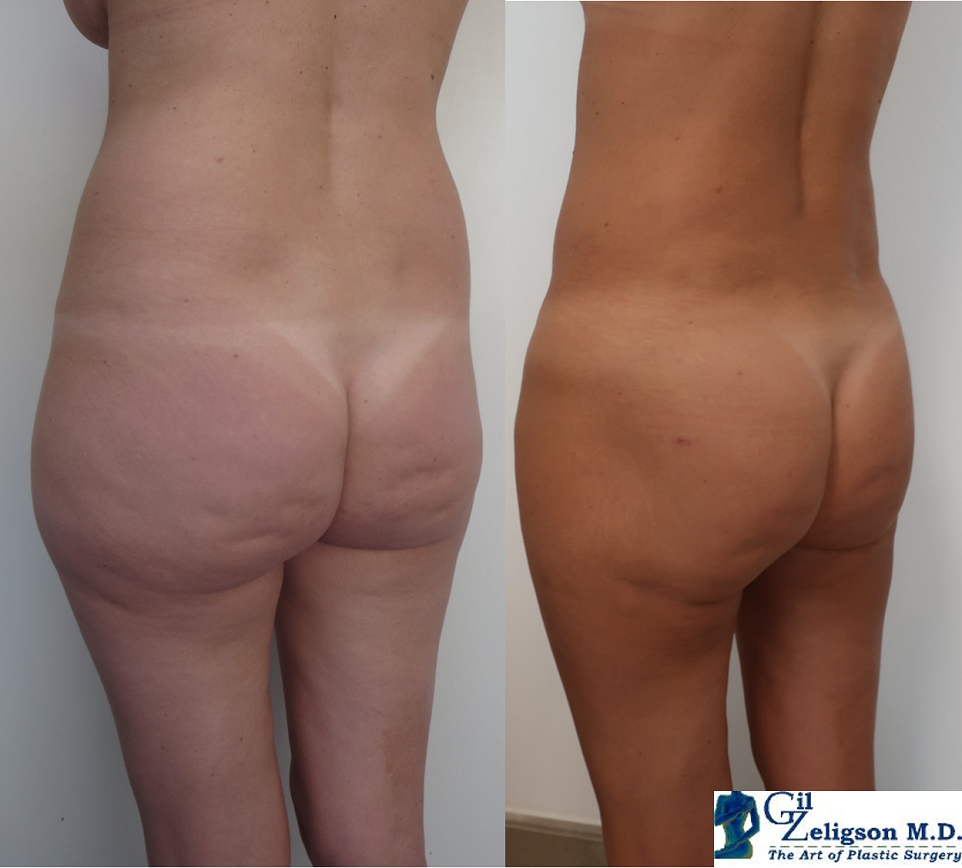 Dr. Gil Zeligson - Liposuction