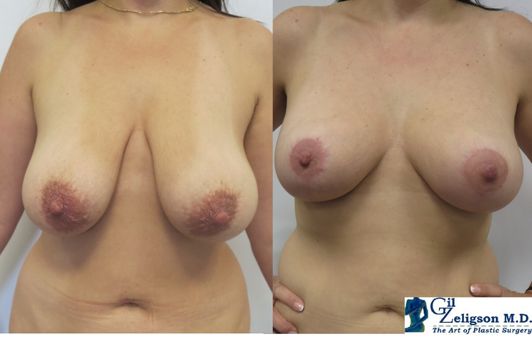 Dr. Gil Zeligson - Breast Reduction