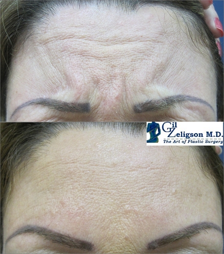 Dr. Gil Zeligson - Botox