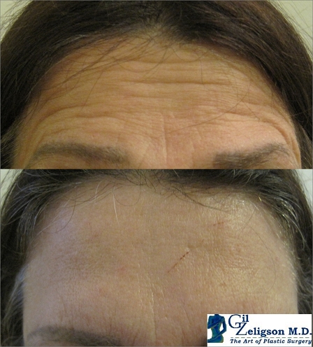 Dr. Gil Zeligson - Botox
