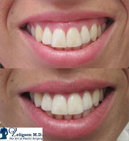 Dr. Gil Zeligson - Botox