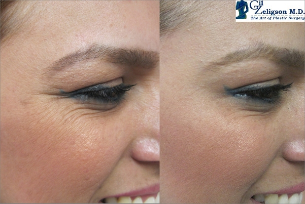 Botox