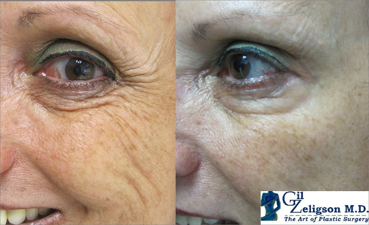 Dr. Gil Zeligson - Botox