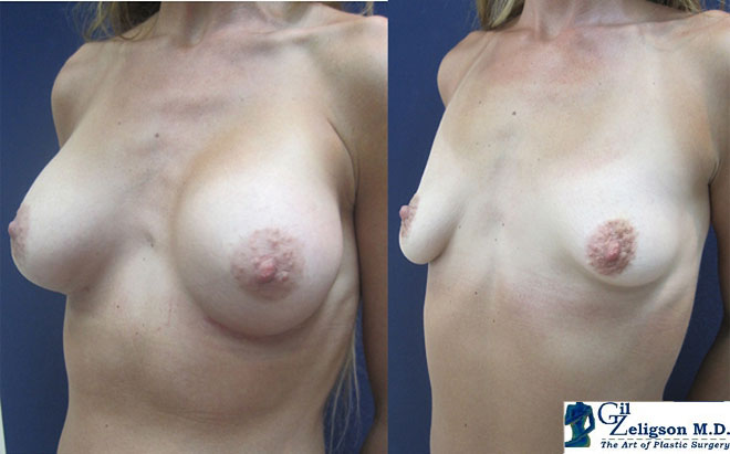 Dr. Gil Zeligson - Breast Asymmetry Correction