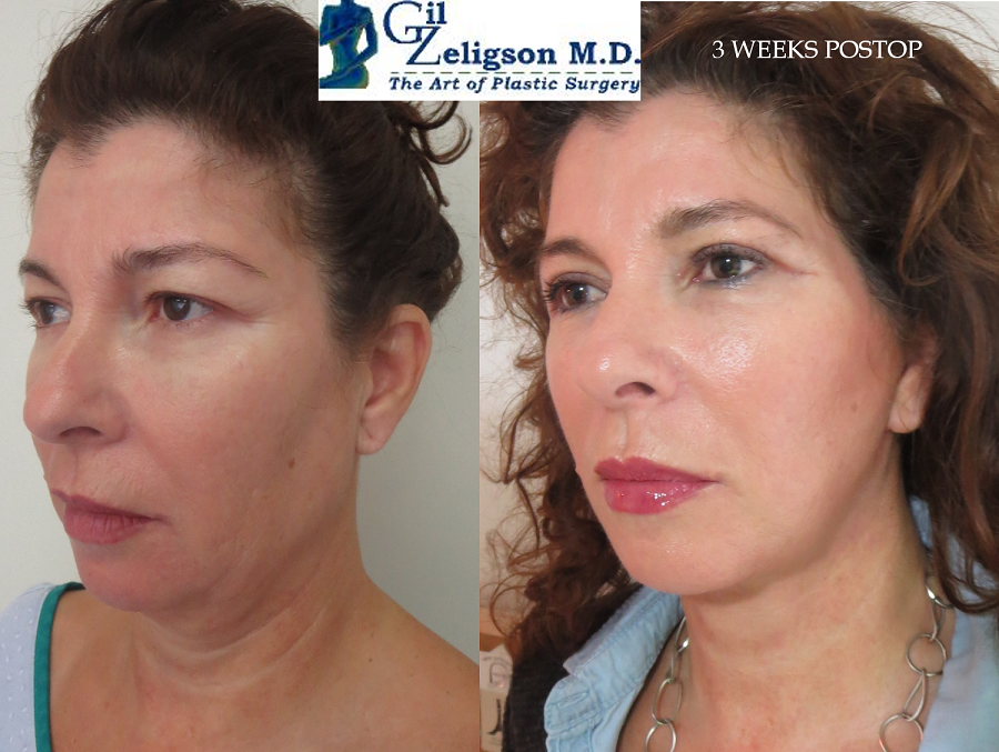 Dr. Gil Zeligson - Facelift