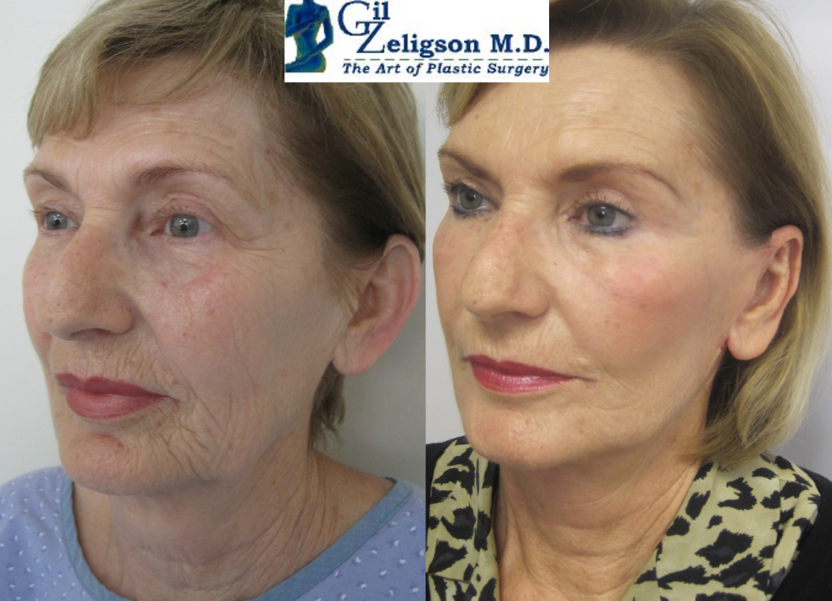 Dr. Gil Zeligson - Facelift