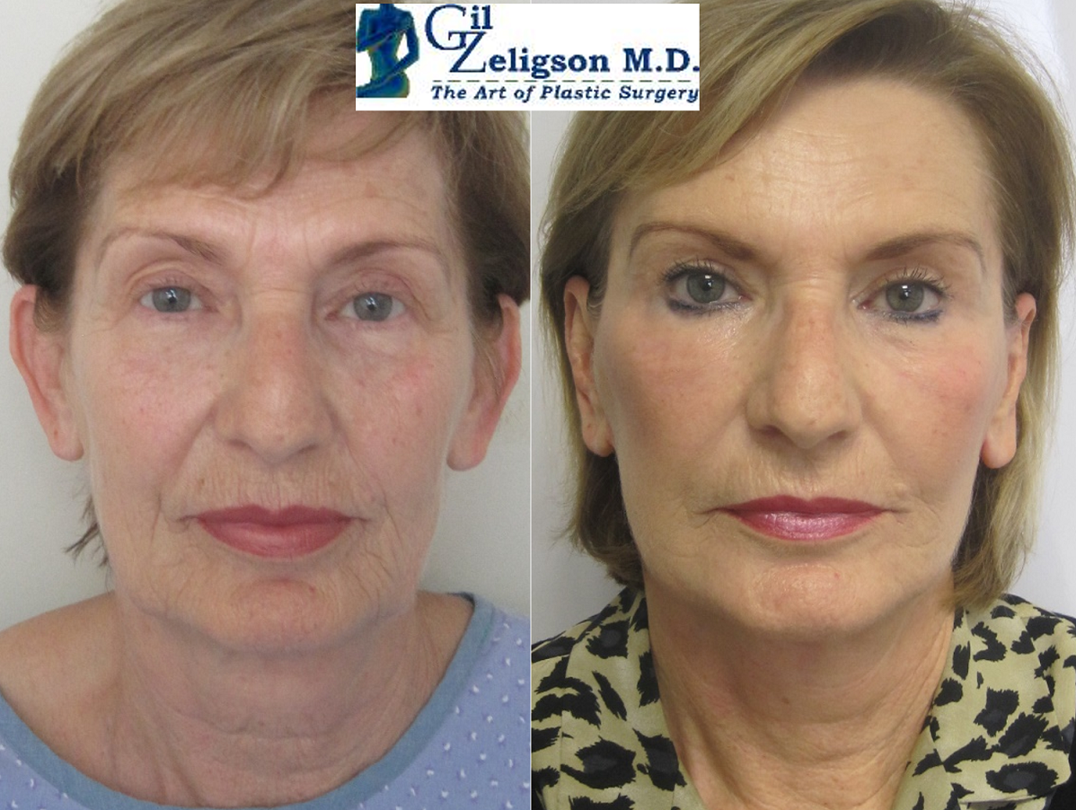 Dr. Gil Zeligson - Otoplasty