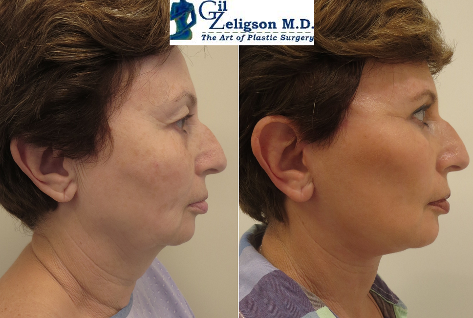 Dr. Gil Zeligson - Facelift