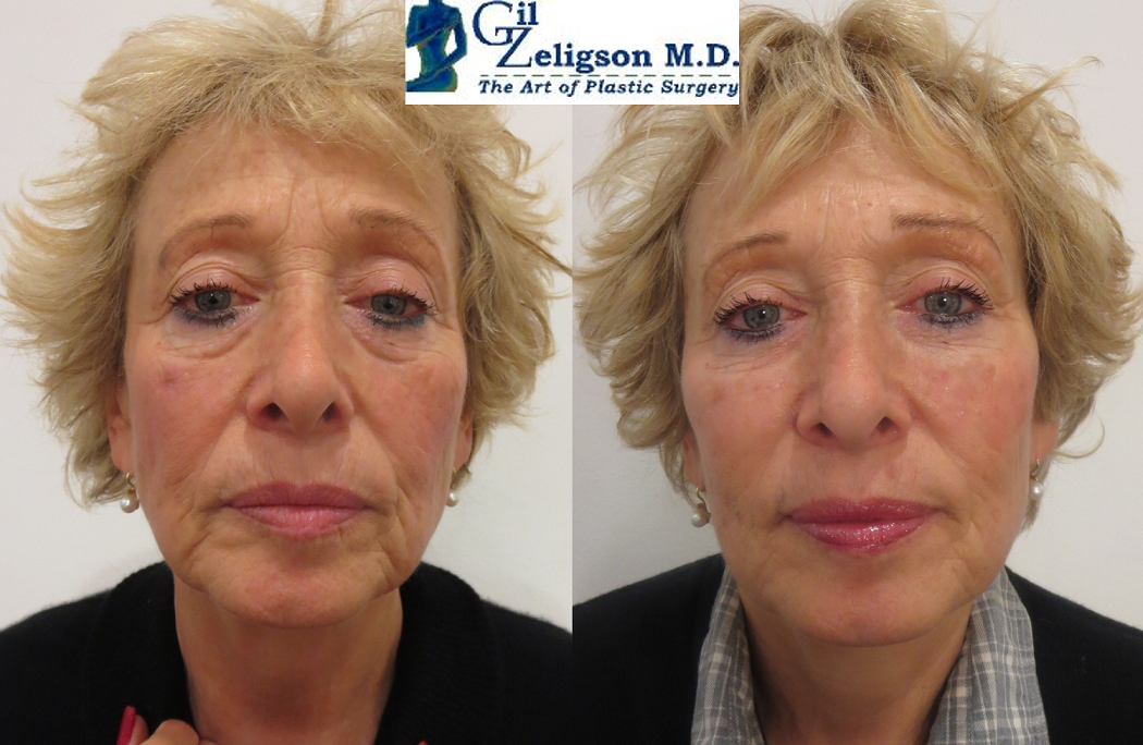 Dr. Gil Zeligson - Facial Sculpturing Hyaluronic acid