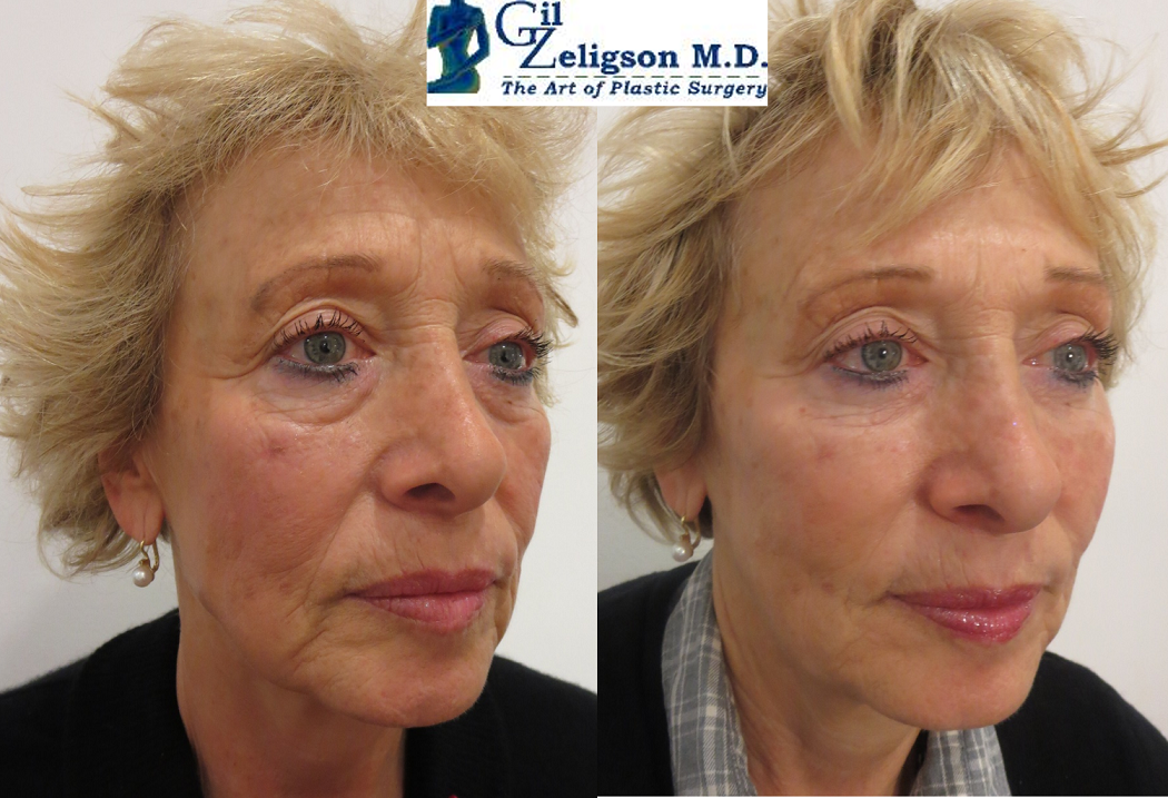 Dr. Gil Zeligson - Facial Sculpturing Hyaluronic acid