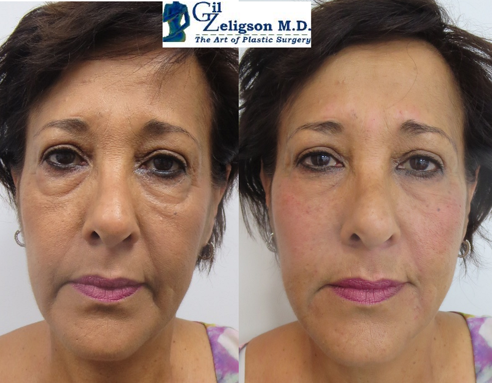 Dr. Gil Zeligson - Facial Sculpturing Hyaluronic acid