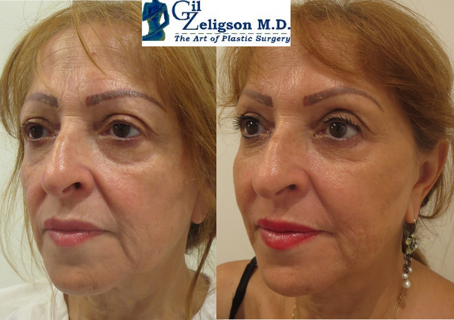 Dr. Gil Zeligson - Facial Sculpturing Hyaluronic acid
