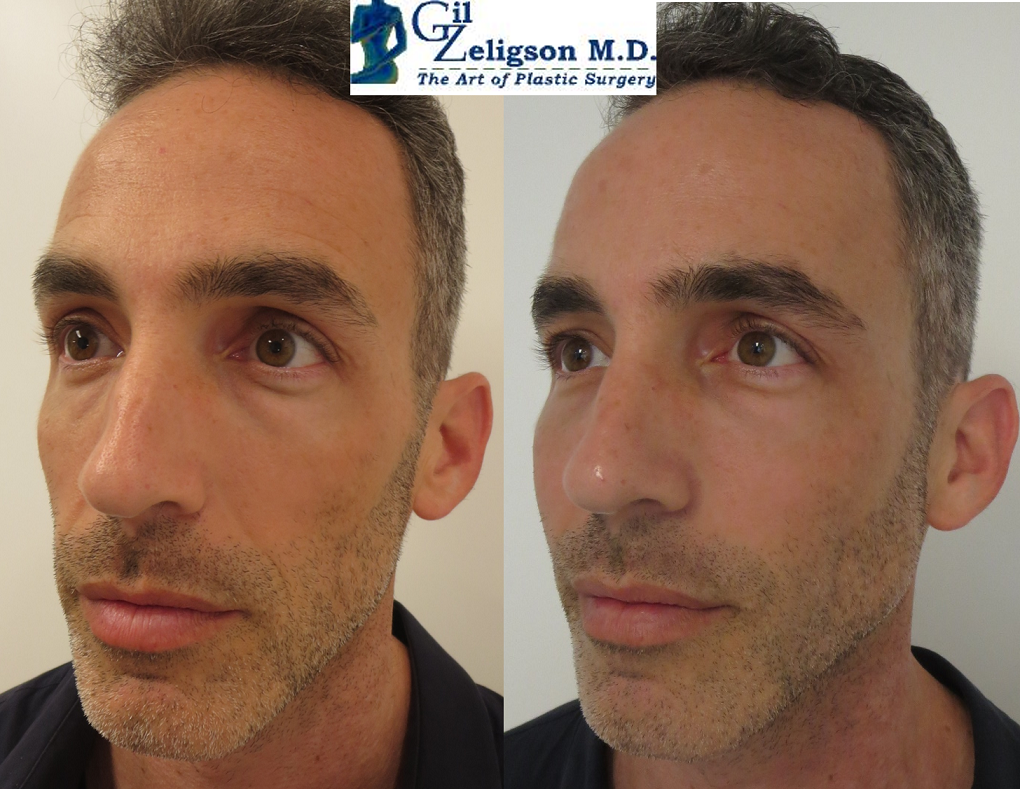 Dr. Gil Zeligson - Facial Sculpturing Hyaluronic acid