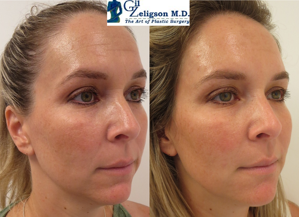 Dr. Gil Zeligson - Facial Sculpturing Hyaluronic acid