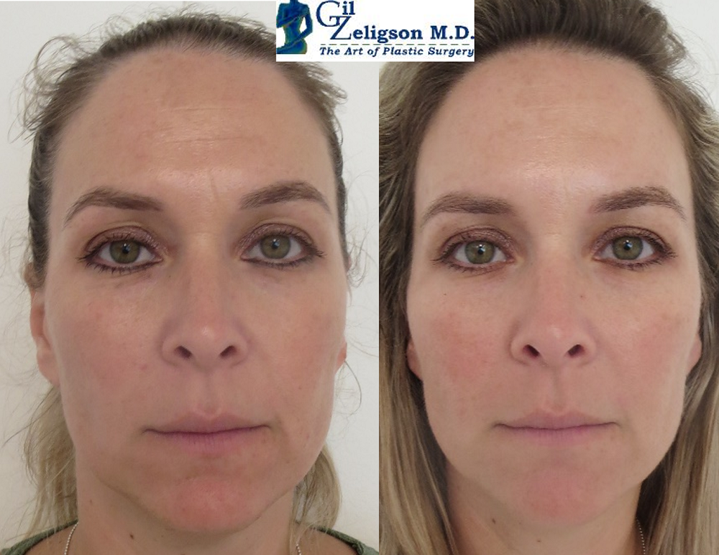 Dr. Gil Zeligson - Facial Sculpturing Hyaluronic acid