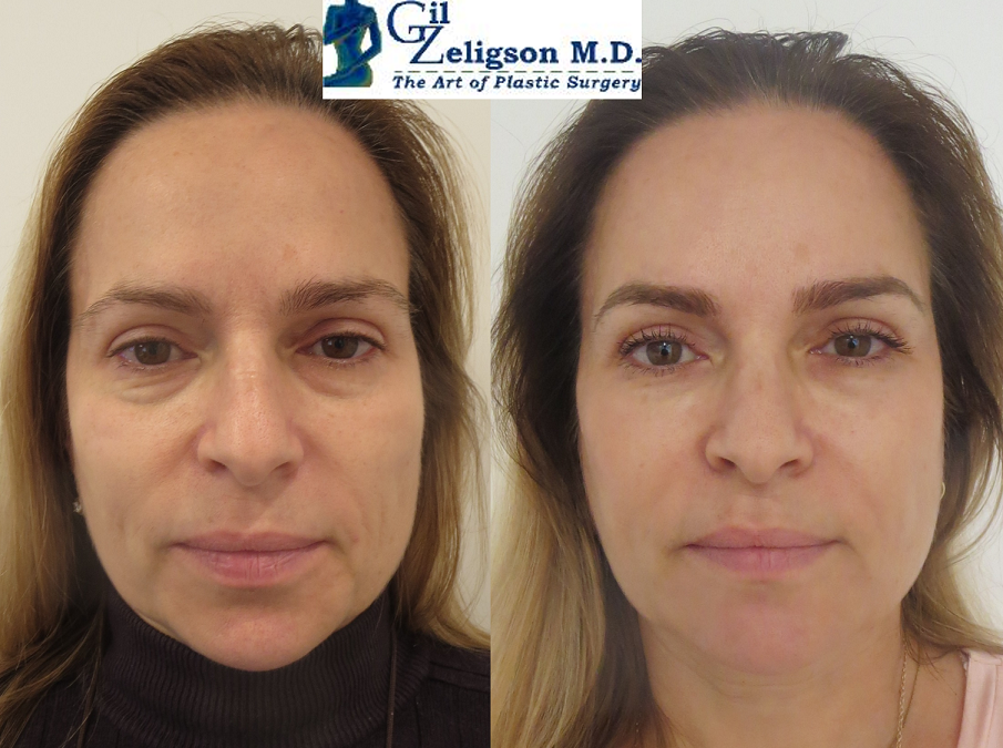 Dr. Gil Zeligson - Facial Sculpturing Hyaluronic acid