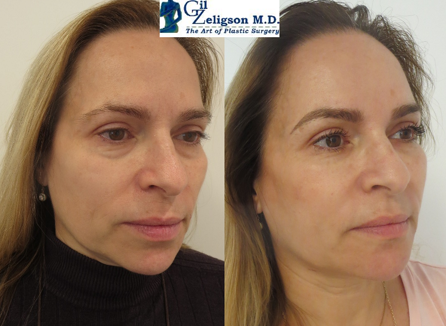 Dr. Gil Zeligson - Facial Sculpturing Hyaluronic acid