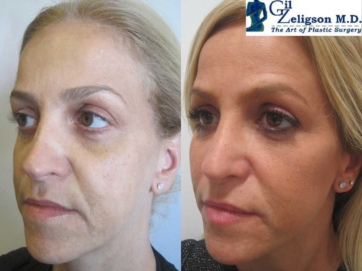 Dr. Gil Zeligson - Facial Sculpturing Hyaluronic acid
