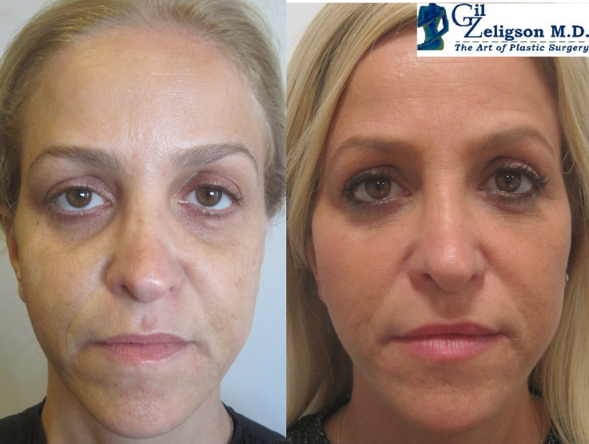 Dr. Gil Zeligson - Facial Sculpturing Hyaluronic acid