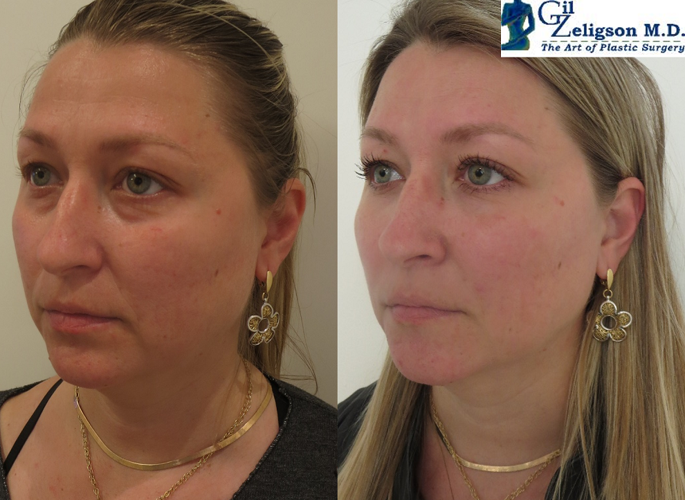 Dr. Gil Zeligson - Facial Sculpturing Hyaluronic acid