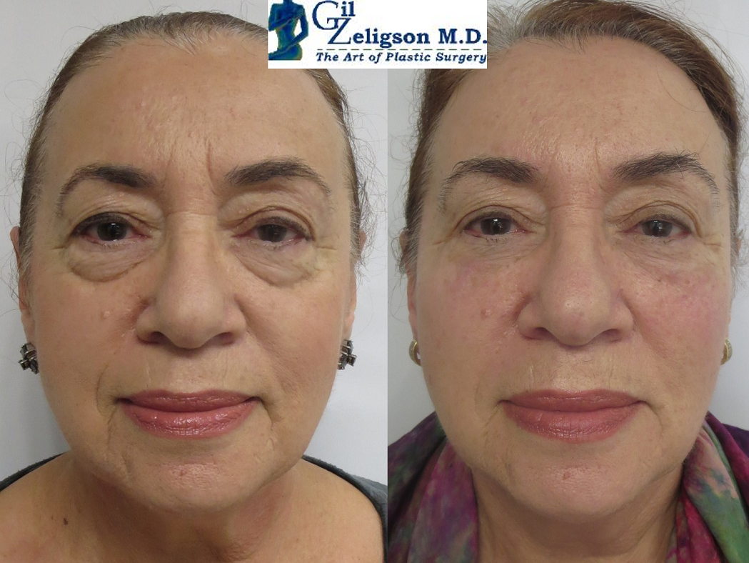 Dr. Gil Zeligson - Facial Sculpturing Hyaluronic acid
