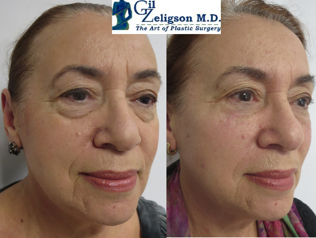 Dr. Gil Zeligson - Facial Sculpturing Hyaluronic acid