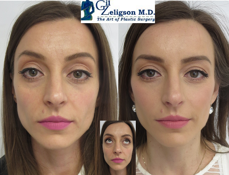 Dr. Gil Zeligson - Facial Sculpturing Hyaluronic acid