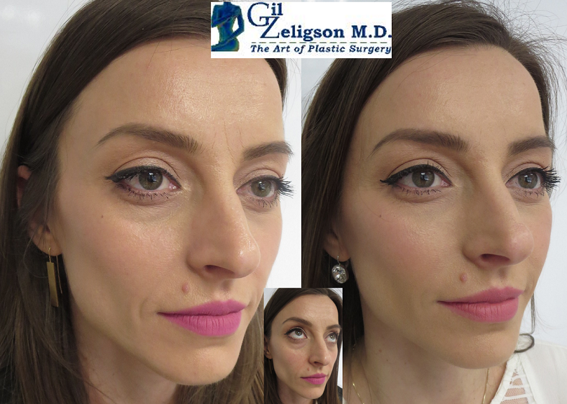 Dr. Gil Zeligson - Facial Sculpturing Hyaluronic acid