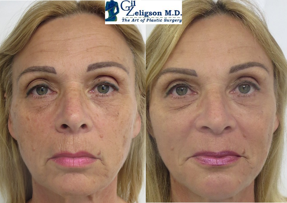 Dr. Gil Zeligson - Facial Sculpturing Hyaluronic acid
