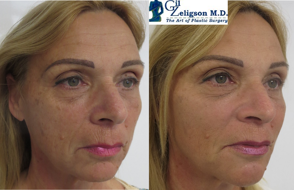 Dr. Gil Zeligson - Facial Sculpturing Hyaluronic acid