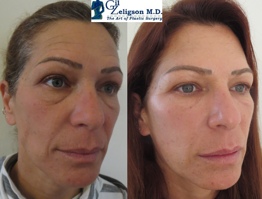 Dr. Gil Zeligson - Facial Sculpturing Hyaluronic acid