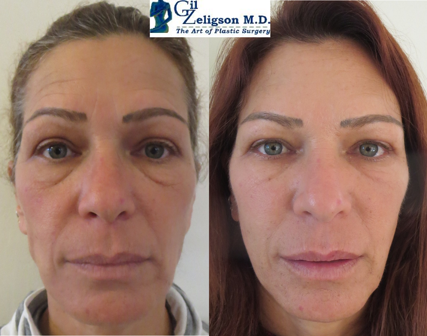 Dr. Gil Zeligson - Facial Sculpturing Hyaluronic acid