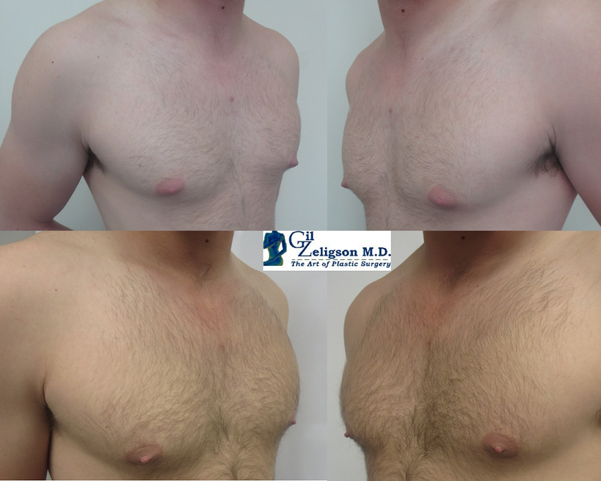 Dr. Gil Zeligson - Gynecomasty