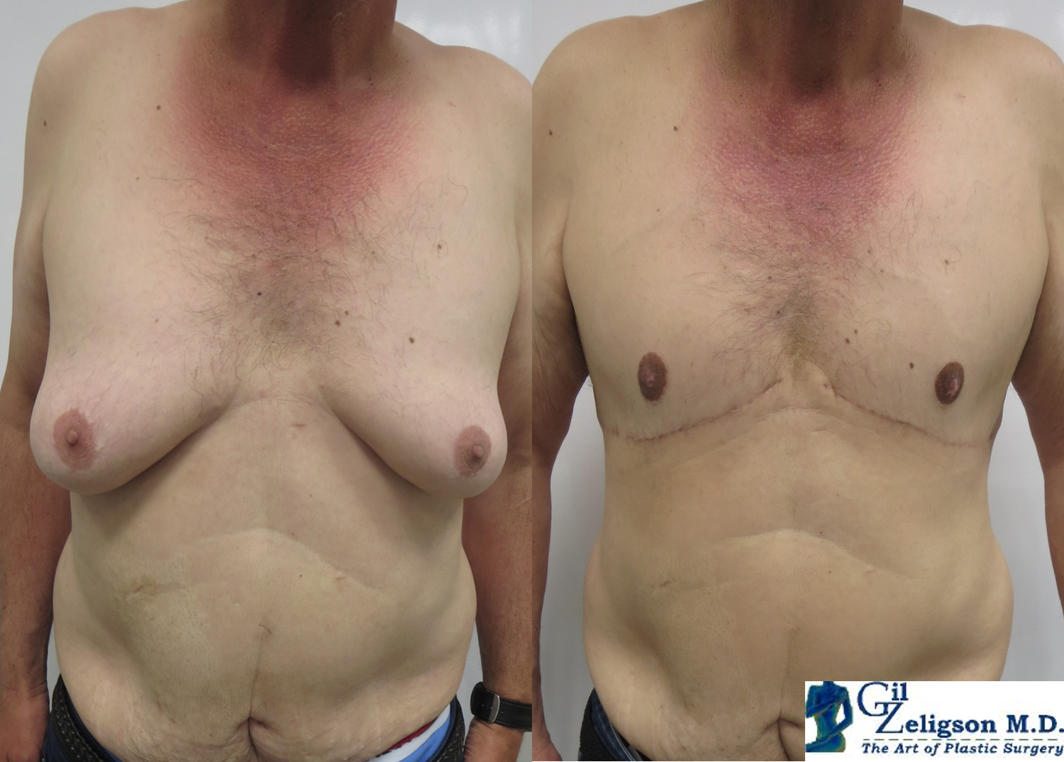 Dr. Gil Zeligson - Gynecomasty