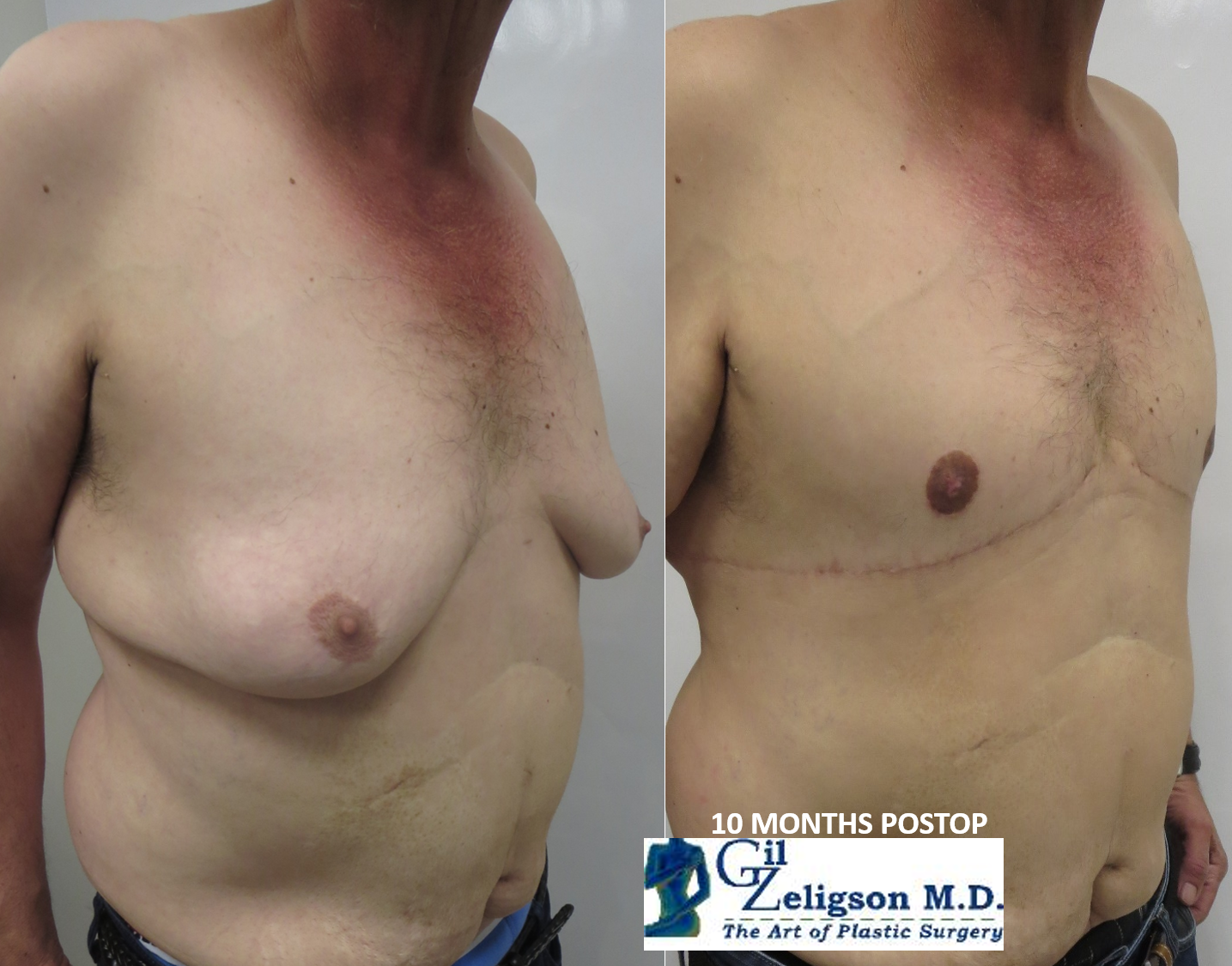 Dr. Gil Zeligson - Gynecomasty