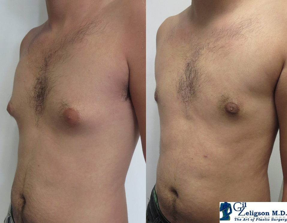 Dr. Gil Zeligson - Gynecomasty