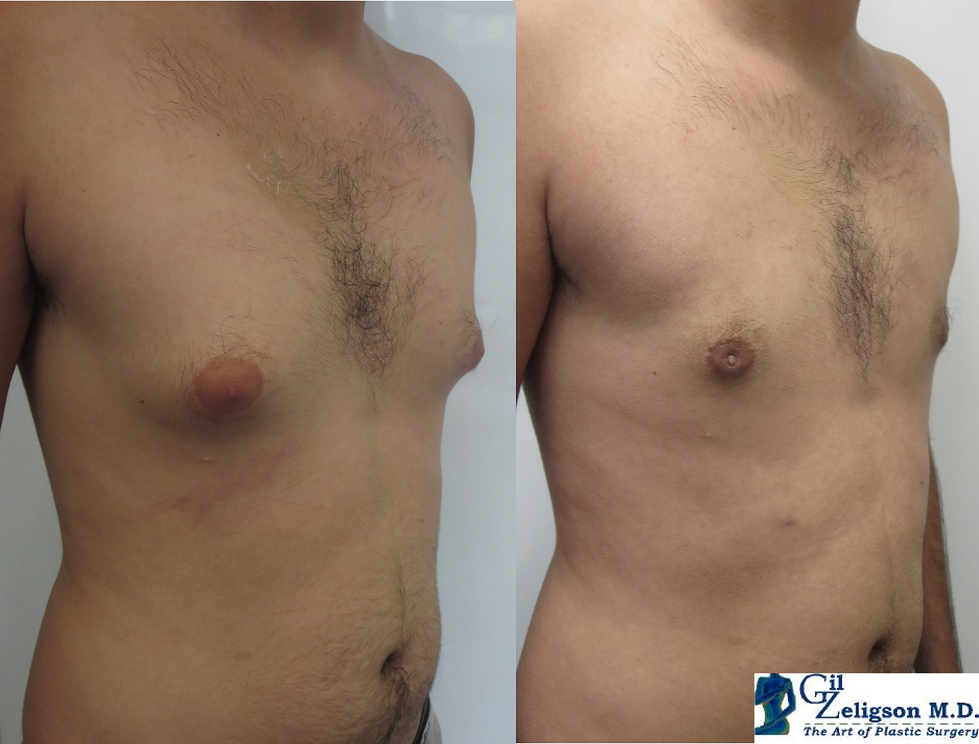 Dr. Gil Zeligson - Gynecomasty