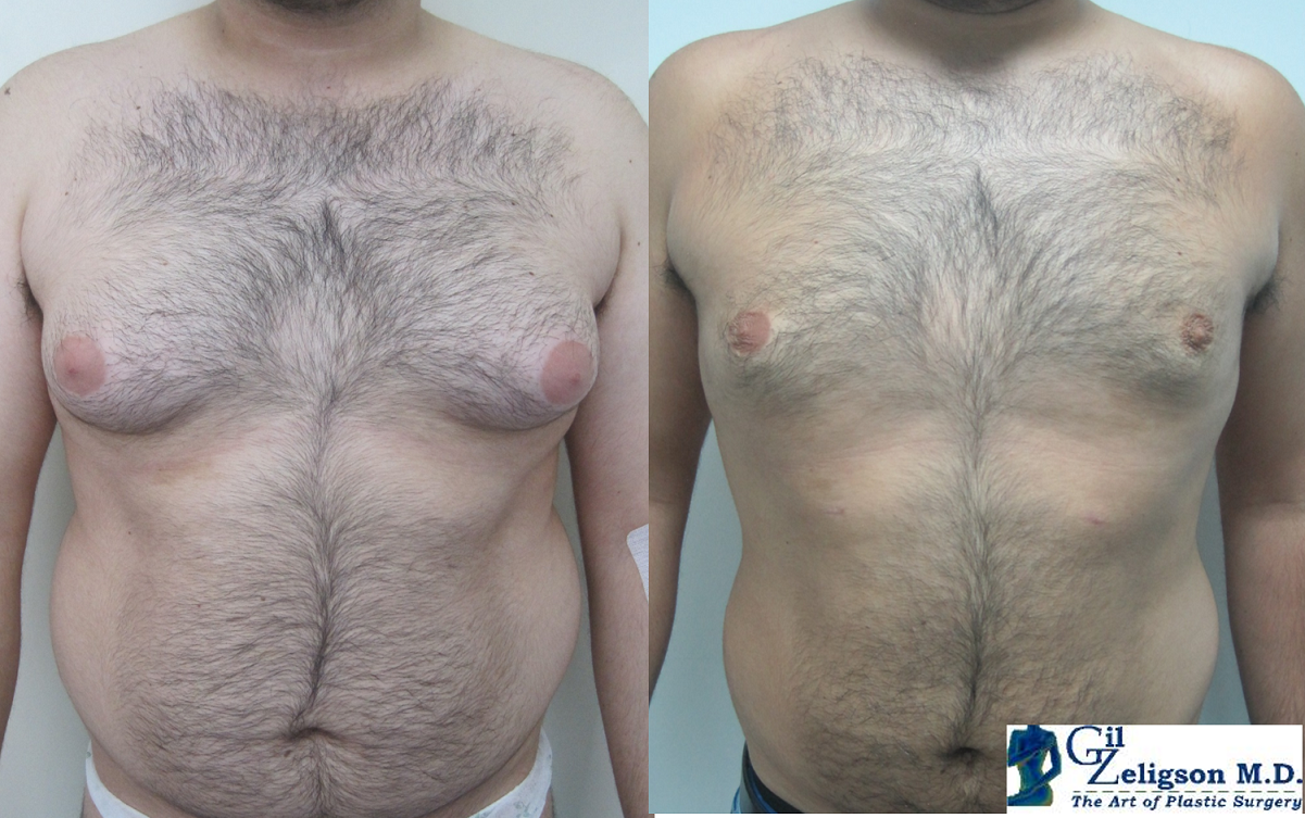 Dr. Gil Zeligson - Gynecomasty