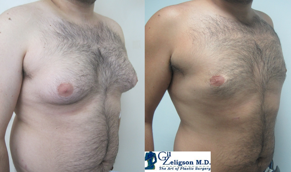 Dr. Gil Zeligson - Gynecomasty